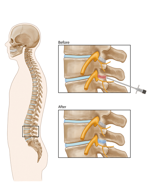 TYPICAL BENEFITS OF FACET INJECTIONS