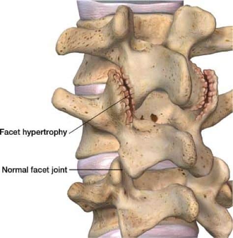 MEDIAL BRANCH BLOCKS